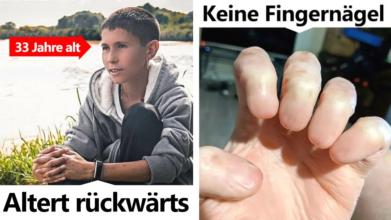 affenkrankheit bei menschen