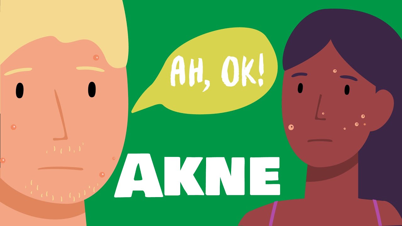 tipps gegen akne