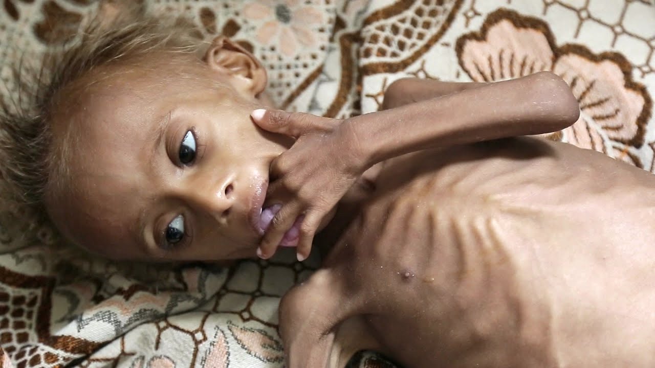 niños desnutridos de africa